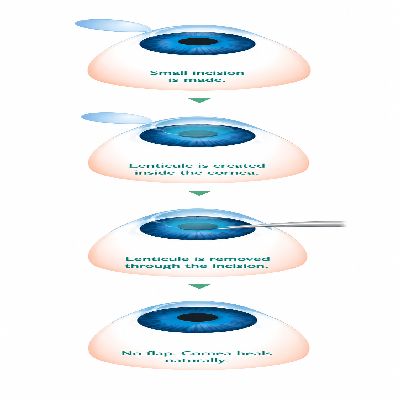 Lenticule-Based Options